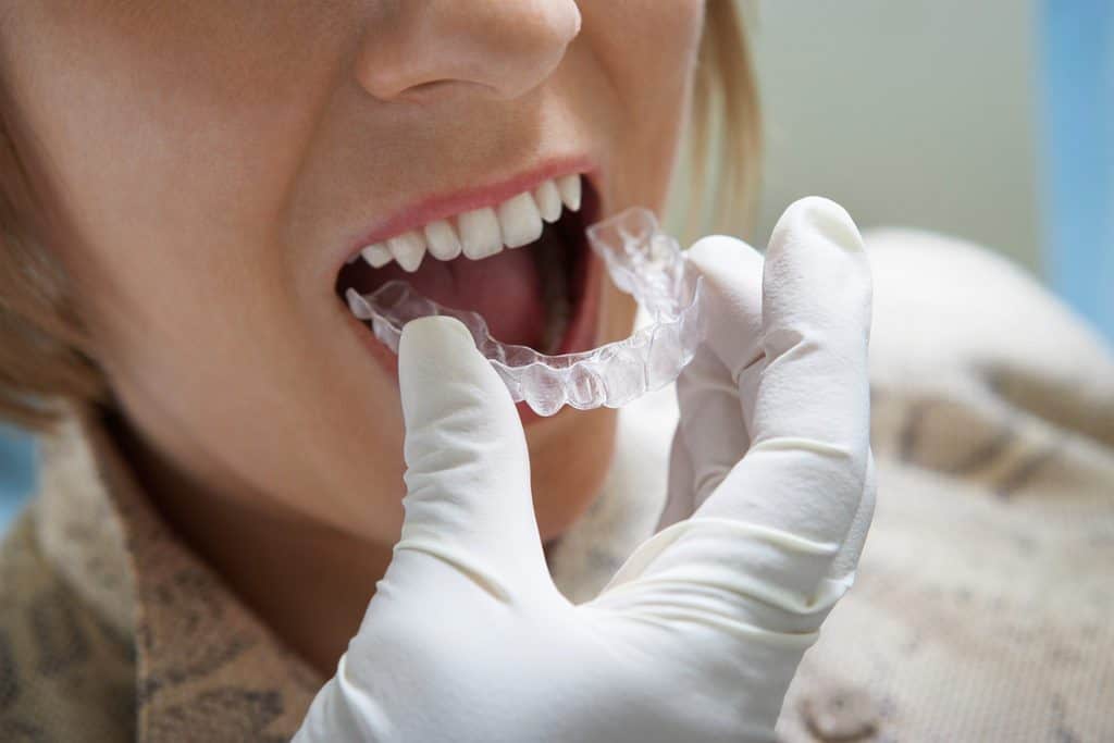 Invisalign Orthodontist in Calgary • Family Braces