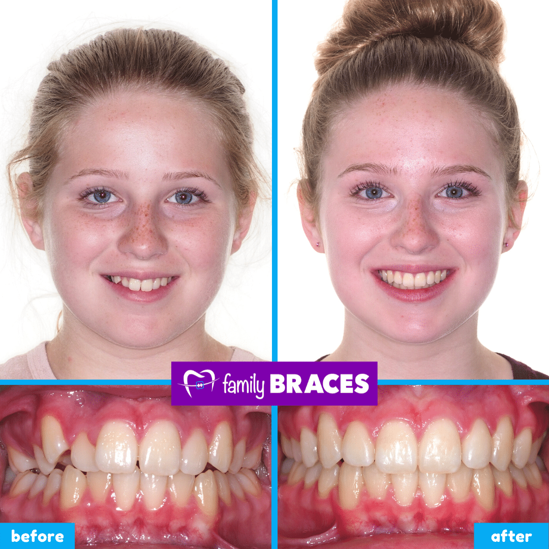 orthodontics before & after 1