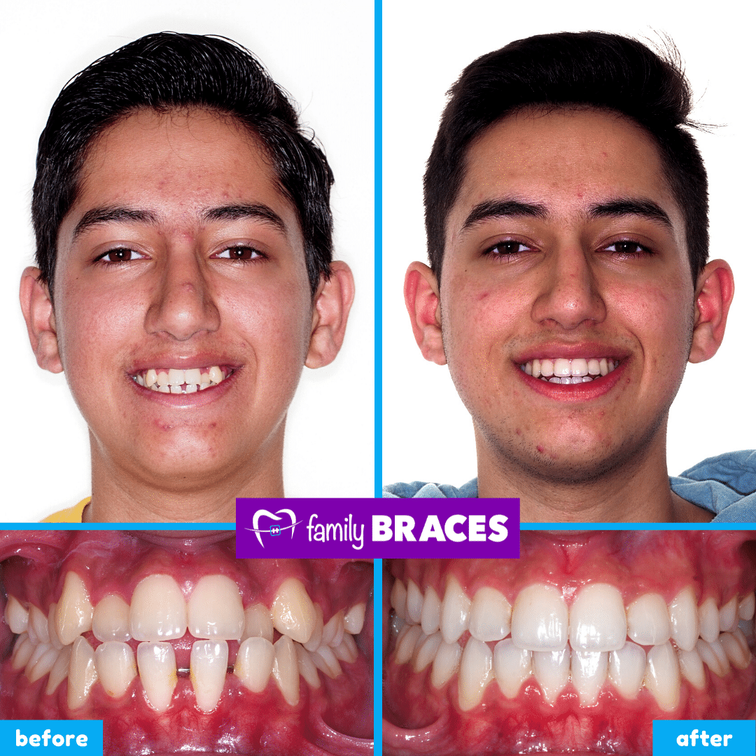 orthodontics before & after 10