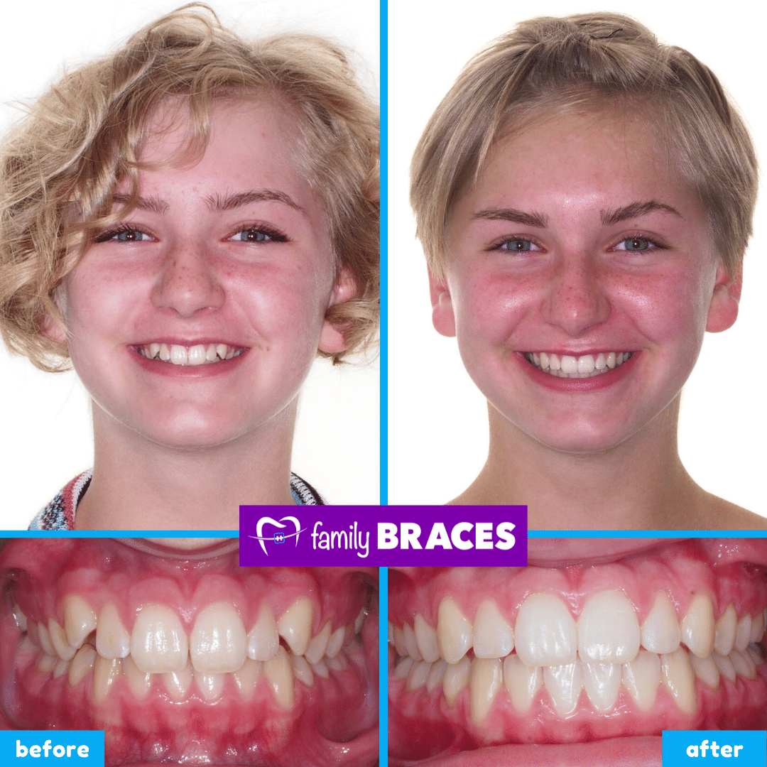 orthodontics before & after 11