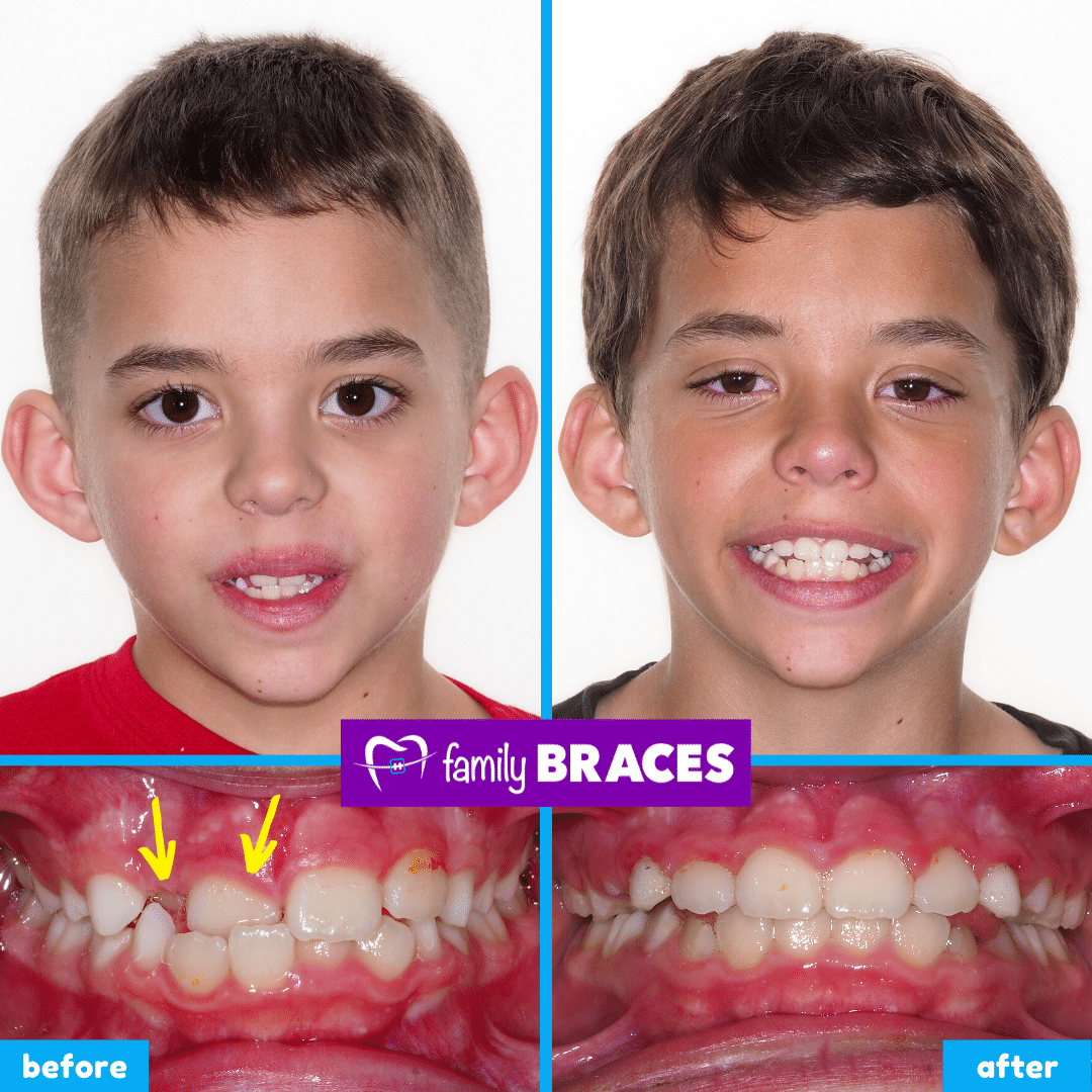 orthodontics before & after 12