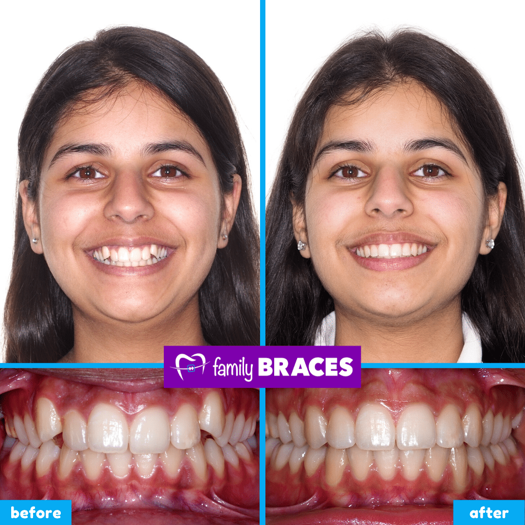 orthodontics before & after 13