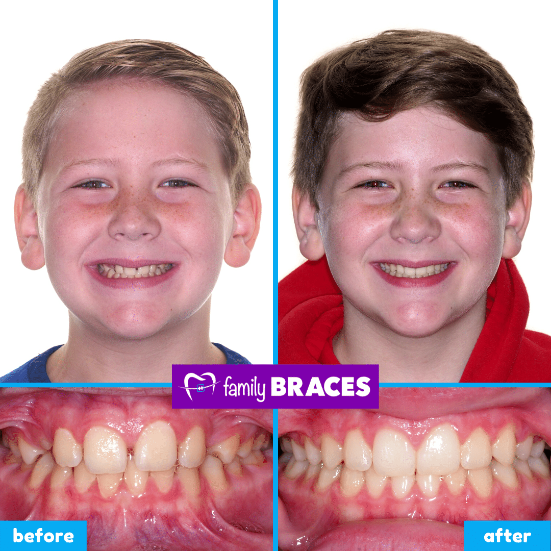 orthodontics before & after 14