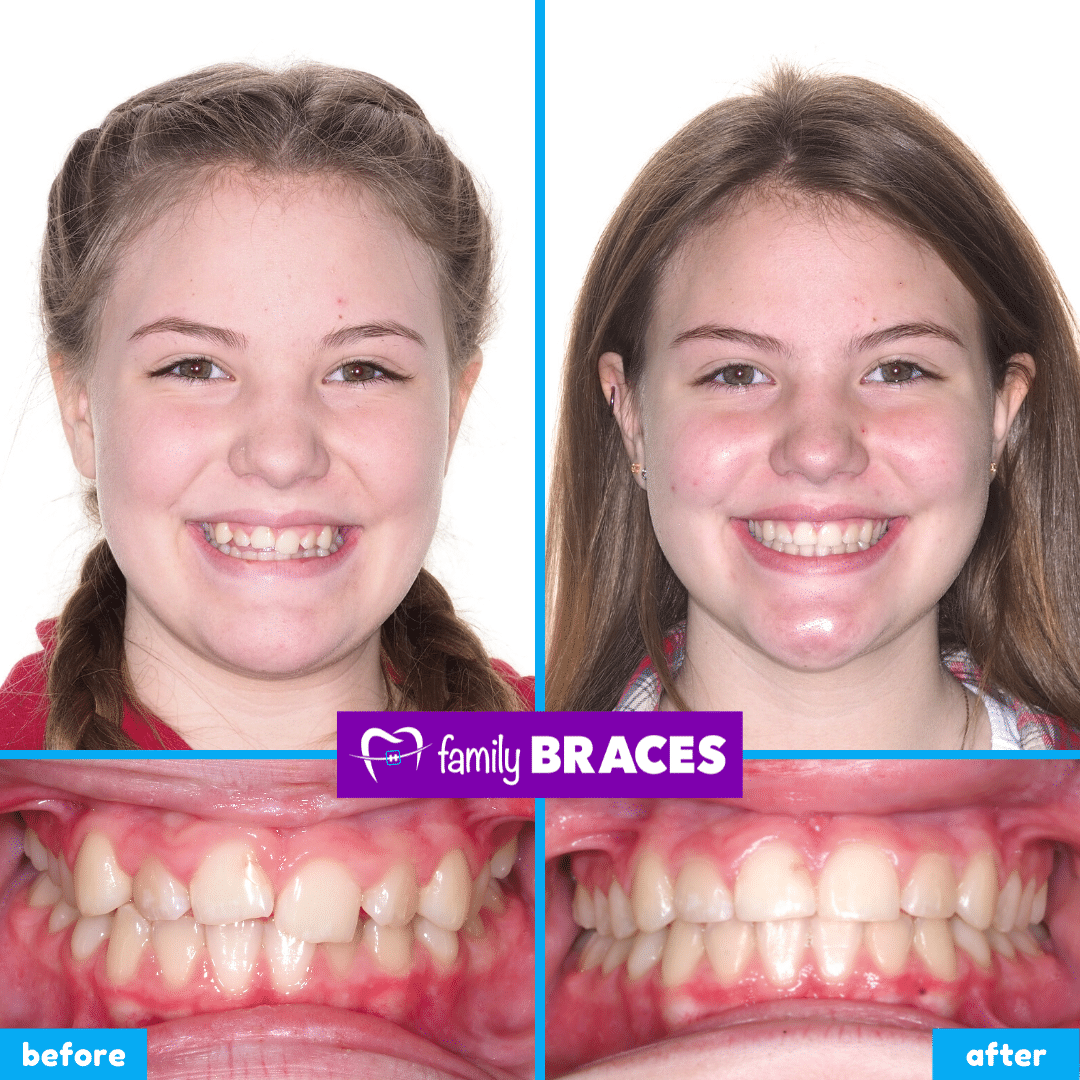 orthodontics before & after 15