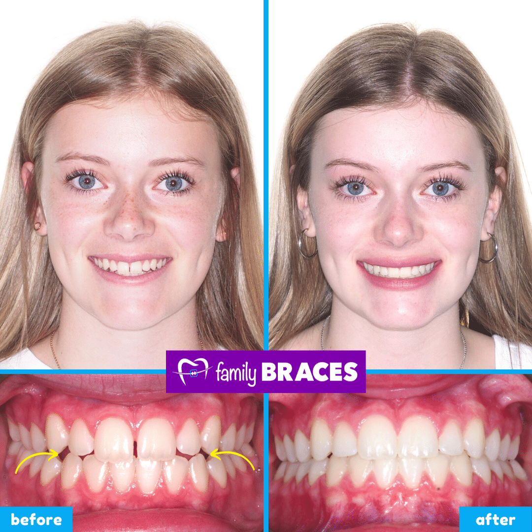 orthodontics before & after 16