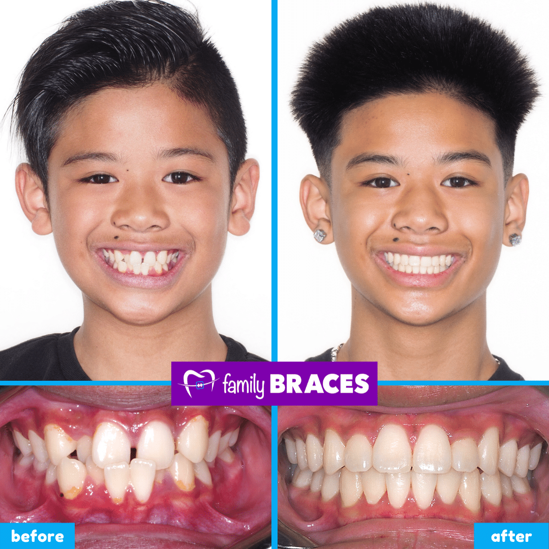 orthodontics before & after 2