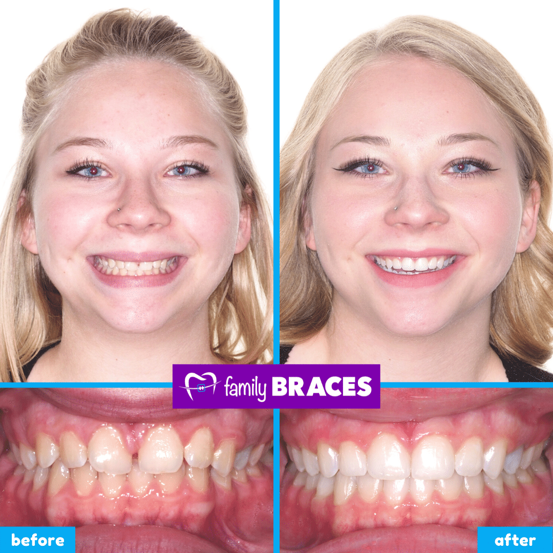 orthodontics before & after 3