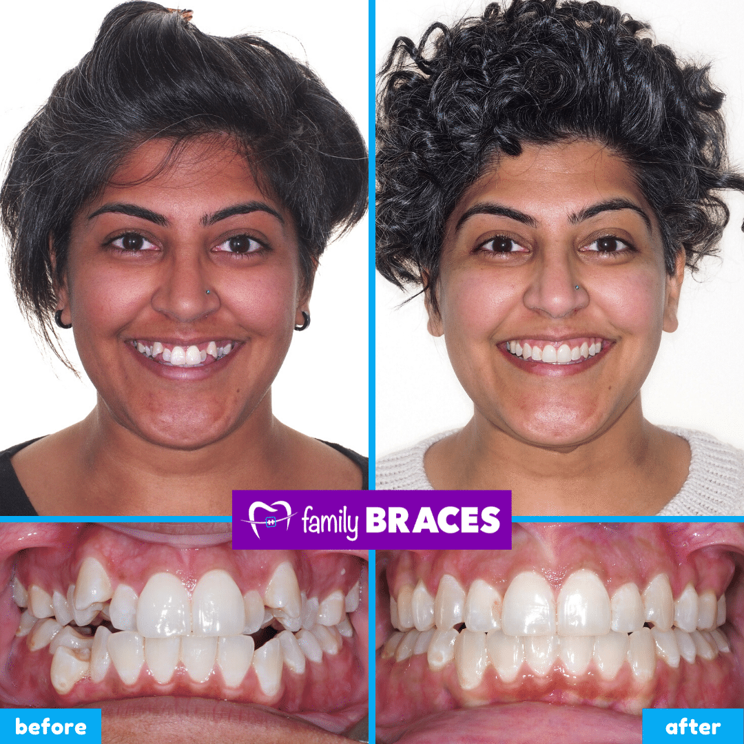 orthodontics before & after 4