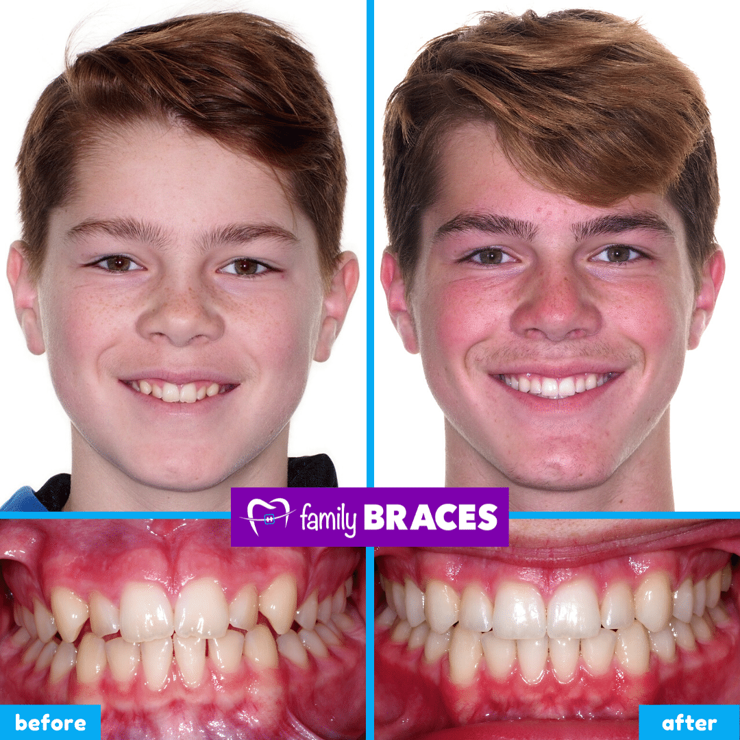 orthodontics before & after 5