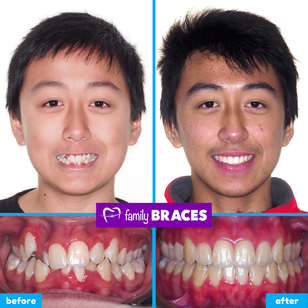 orthodontics before & after 6