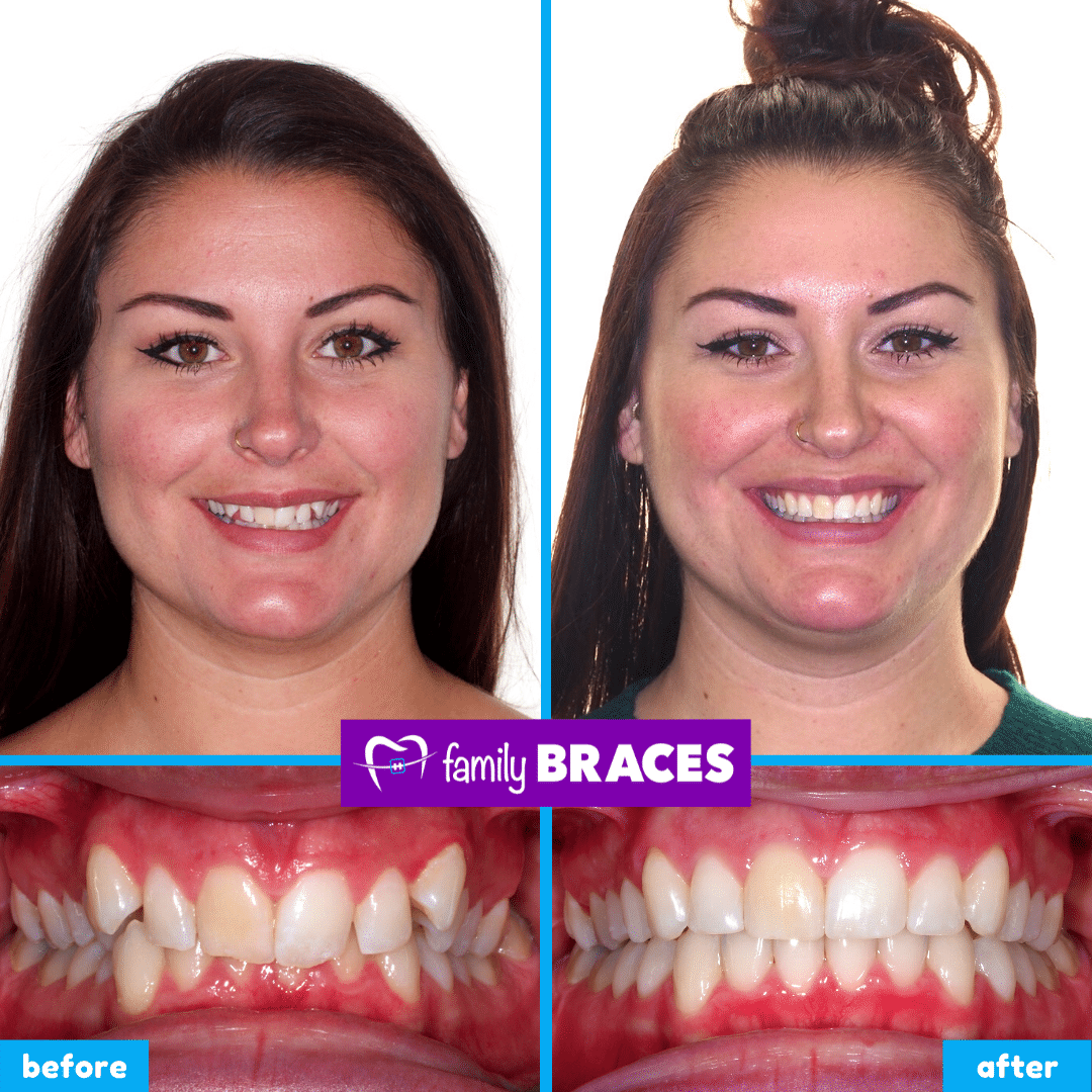 orthodontics before & after 7