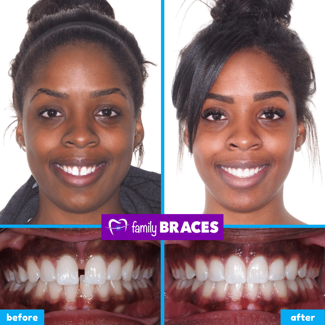 orthodontics before & after 8