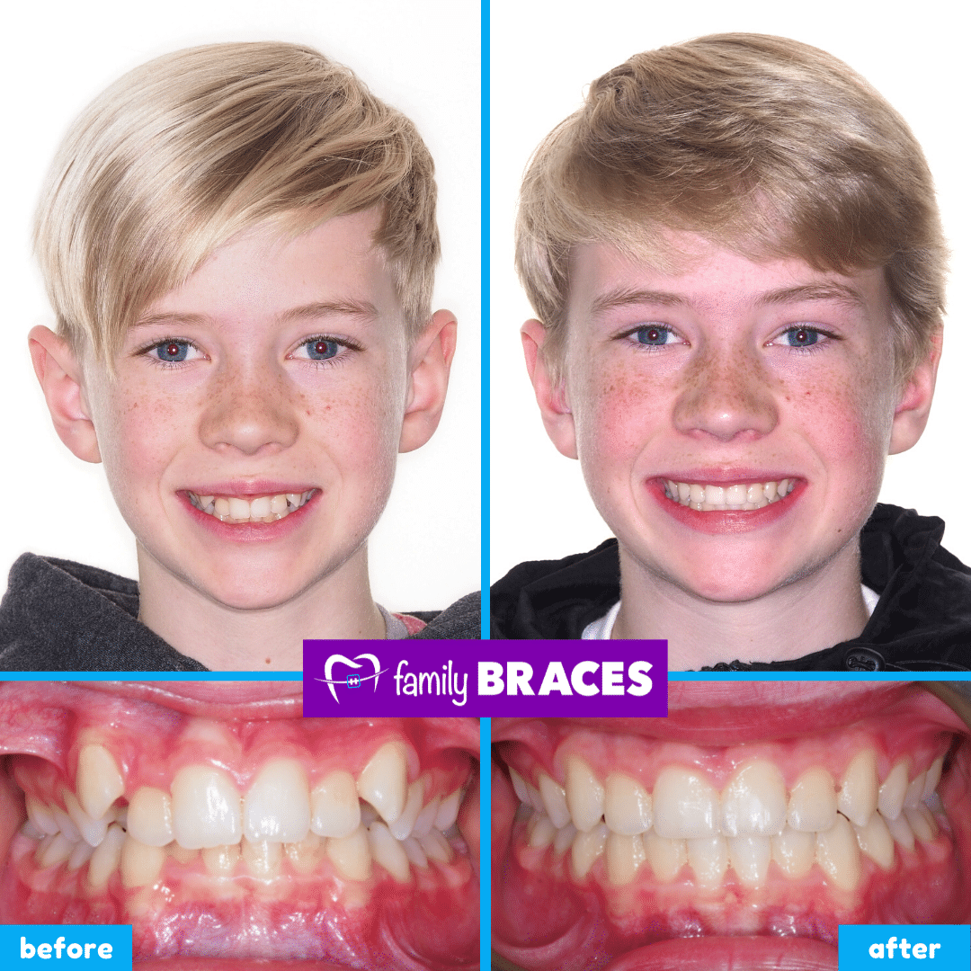 FAMILY BRACES • Calgary Orthodontist for Braces & Invisalign