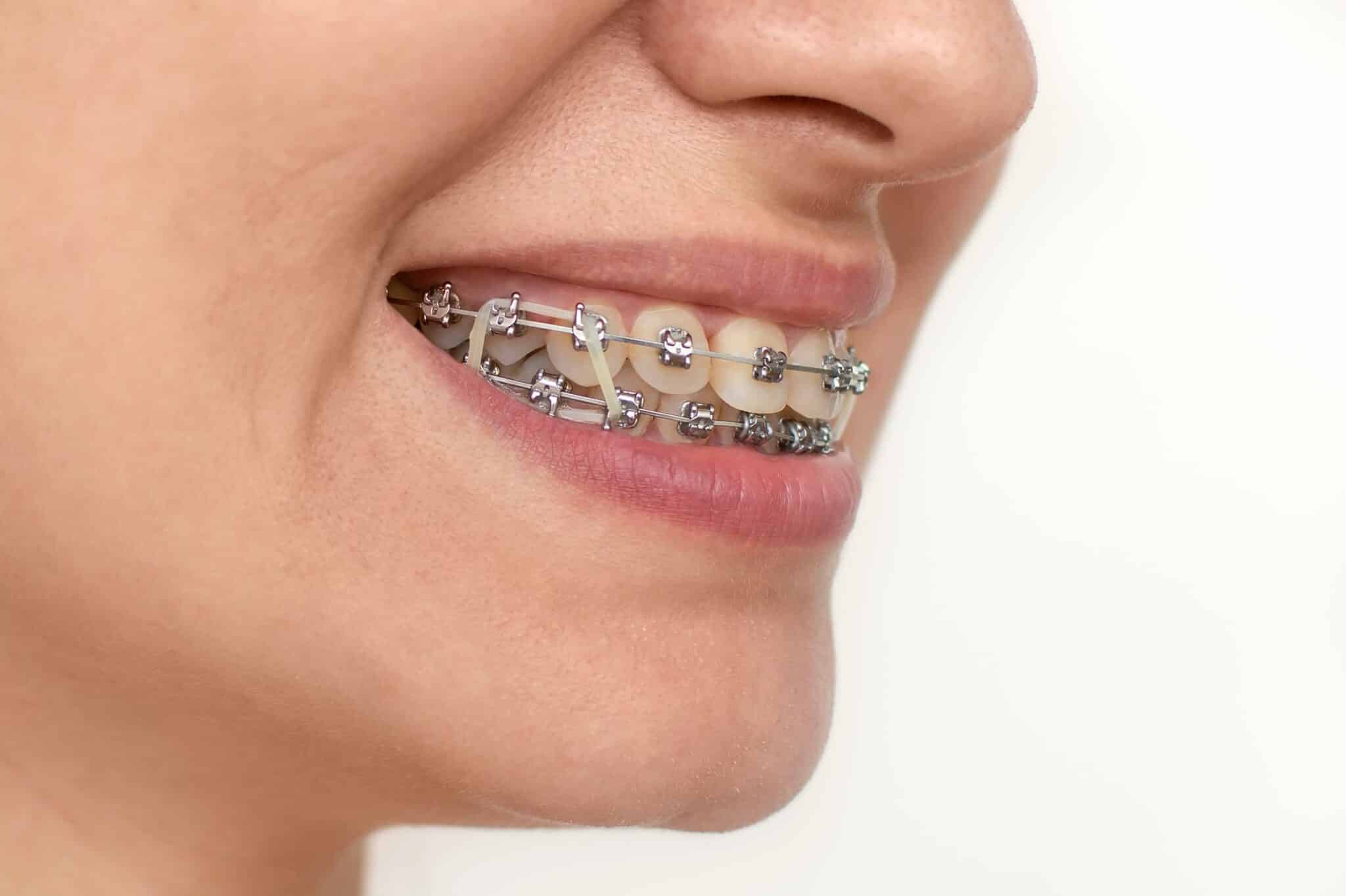 The History of Orthodontic & Braces Family Braces