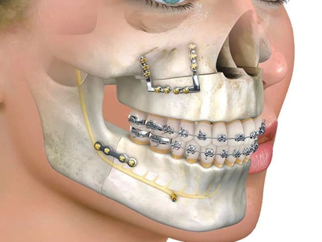 An Underbite Might Be Improved by Traditional Braces - Orthodontic Blog, Orthodontic Specialists of Lake CountyOrthodontic Blog