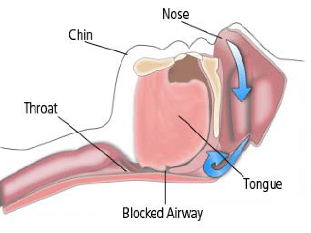 How an orthodontist can help with obstructive sleep apnea