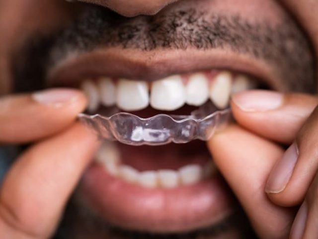 Man putting in Invisalign tray