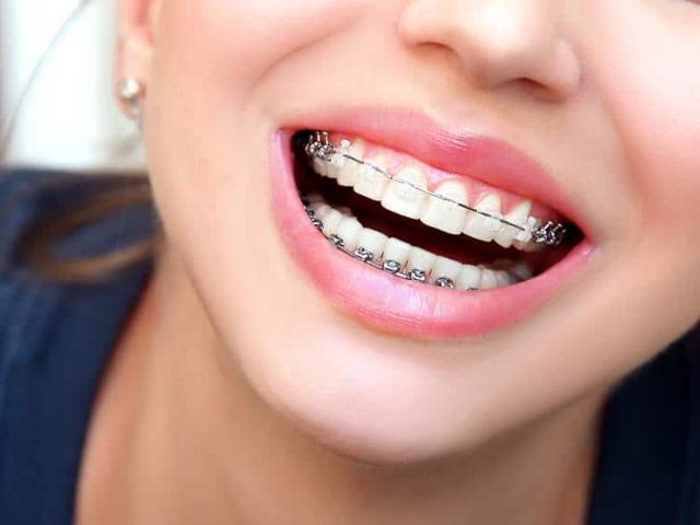 orthodontic treatment questions