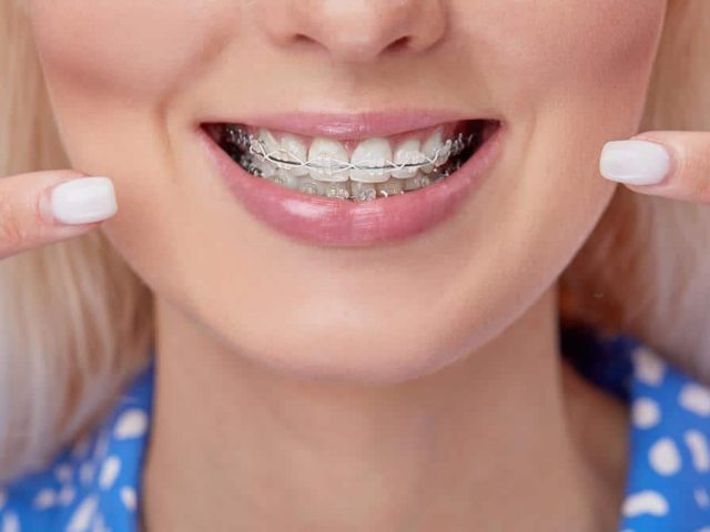 Invisalign Clear Braces