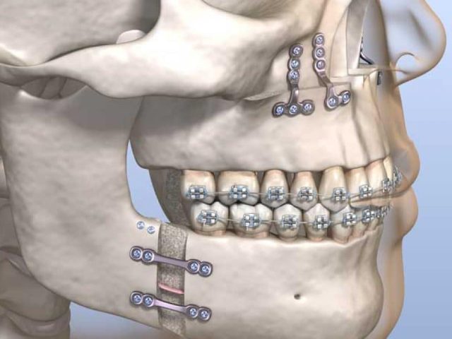 Can Orthodontic Treatment Cure Sleep Apnea?