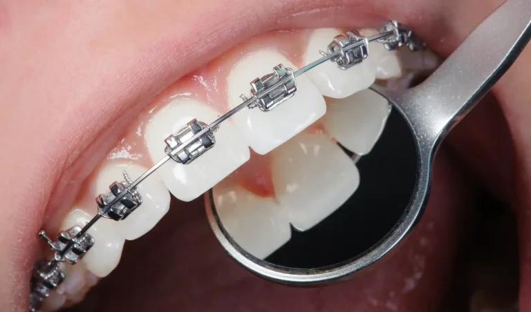 what-are-medical-benefits-of-braces